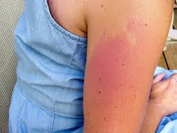 rash and itchiness