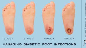 Looking for first diabetes symptoms? Diabetic Foot Ulcer Causes Symptoms Treatment In Lubbock Tx