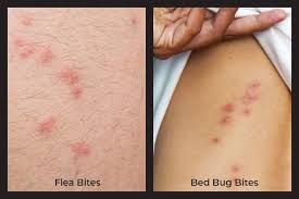 Image result for bedbugs bites
