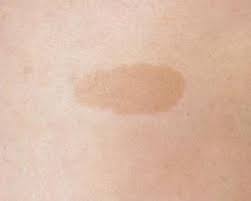 Ciltte Leke Olusma Nedenleri Nelerdir Uzmantv