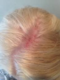 Hair Dyed Allergic Reaction Netmums