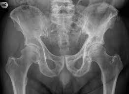 Paget Disease Of The Pelvis Radiology Case Radiopaedia Org