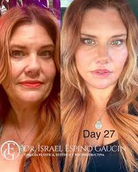 Your transformation is inspiring. Just 27 days after surgery, your beauty  shines through with confidence and grace. Thank you for trusting us and  sharing your results. #EspinoLift Don't forget to follow us