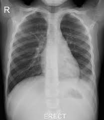 A lobar pneumonia is an infection that only involves a single lobe, or section, of a lung. Left Lower Lobe Pneumonia Radiology Case Radiopaedia Org