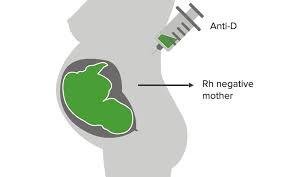 Image result for Rh Sensitization