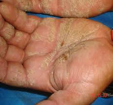 Image result for dermatitis contacta toxica
