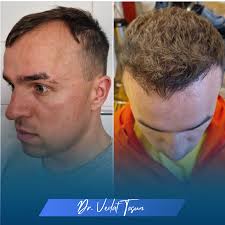 Leading Provider of Hair Transplantation Services in Turkey