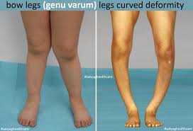Image result for Genu Varum