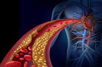 Combien de stents peut on recevoir. Angioplastie Stent Duree Principes Convalescence