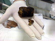 Déjà, la prise de poids inarrêtable une fois la vésicule enlevé même avec une alimentation pourtant plus saine et plus légère. Lithiase Biliaire Wikipedia