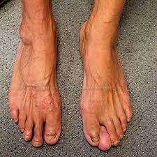 What does cancer look like? A Mass On The Big Toe For More Than 10 Years Bonetumor Org