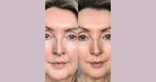 Aletia’s journey to smoother, firmer skin with our Plump Up Microneedle ⭐