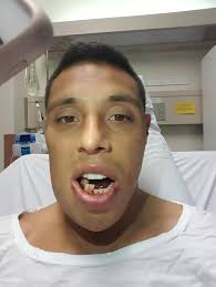 Anthony Tupou shows off the extent of his jaw injury : r/nrl