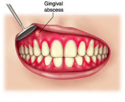 Abcesul dentar este una din cele mai frecvente urgențe stomatologice. Video Abcesul Dentar Dentistul Info