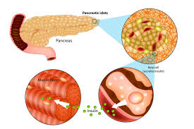 What Is Type 1 Diabetes Overview Including Symptoms