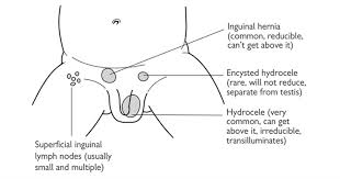Image result for Inguinal hernia child
