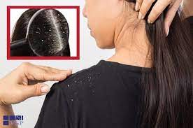 10 Remedes De Grand Mere Contre Les Pellicules La Sante Naturellement Pellicule Cheveux Remede Contre Les Pellicules Comment Eliminer Les Pellicules