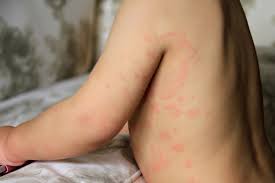 Rhinovirus is the most common cause of colds in both adults and children. Urticaria Causes Treatment Of Hives Qoctor Your Quick Online Doctor
