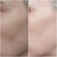 Ich erkläre euch microdermabrasion und zeige am beispiel wie die behandlung angewendet wird. Fruchtsaurepeeling Test Vergleich 2020 Neu Vorher Nachher Bilder