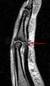After surgery, your forearm and hand will be in a large bandage and plaster splint. Flexor Tendon Injuries Radsource
