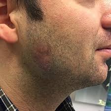 Image result for Sialolithiasis