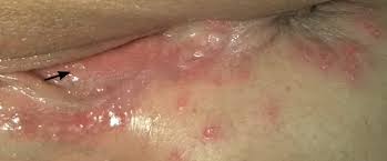 They may still shed the virus, though, even when no symptoms are present. Genital Herpes Clinical Feature Management Teachmeobgyn