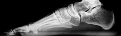 Image result for Osteomyelitis XRay