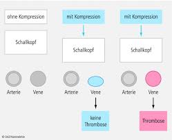 Die Tiefe Venenthrombose