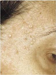 Braf Mutations In Multiple Sebaceous Hyperplasias Of Patients Belonging To Myh Associated Polyposis Pedigrees Sciencedirect