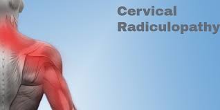 Check spelling or type a new query. Cervical Radiculopathy Symptoms Treatments Legacy Spine Neurological Specialists