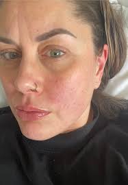 Hello everyone. Thyroid gland was removed 5 years ago. A year ago, pains in  the joints, muscles, dry mouth and eyes and occasional anxiety started.  Everything was attributed to hypothyroidism, but since