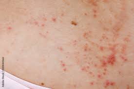Image result for sweat rash on back