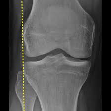 Image result for Knee XRay