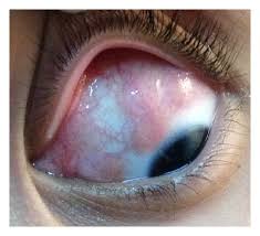 Image result for lesion sclera