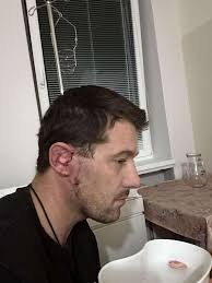 Exostosis/Surfer's Ear and Kayakers