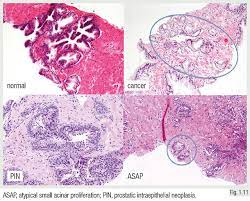 This review focuses on histopathological aspects of carcinoma of the prostate. Tumours Of The Prostate Oncologypro