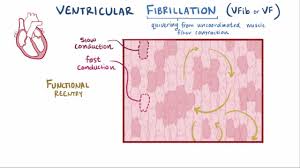 Image result for Ventricular Fibrillation