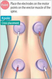 Chapter 5 Therapeutic Points In Nmes Neuromuscular