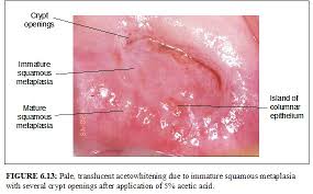 Image result for Colposcopy Findings