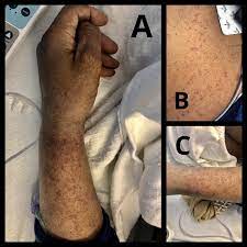 Moderna's vaccine is causing a rash on some people's arms after injection. Cureus Purpuric Rash And Thrombocytopenia After The Mrna 1273 Moderna Covid 19 Vaccine