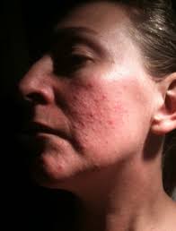 People who suffer from rosacea can often find that their skin is sensitive and should follow a suitable skincare regime: Code Red For Rosacea Spa Clinic