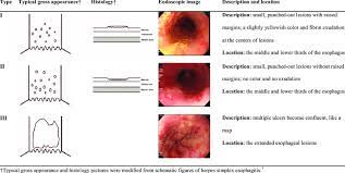 Commonly seen in aids patients. Classifications Of Herpes Esophagitis Gross Appearance Vs Endoscopic Download Table