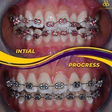 Kenapa memilih implant gigi di klinik gigi senyum ceria. Klinik Pergigian Dental Pavilion Home Facebook