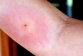 More so, spider bites are usually bigger than an average insect bite. What Does A Spider Bite Look Like Pictures And Symptoms