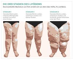 Lipodem Behandlung Fettabsaugung Bei Medical One