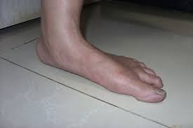 When hoes wear ridiculous heels, drink too much, and have more than moderate difficulty walking, usually resulting in unsightly blisters and lacerations to the cankles and feet. Foot Deformities Amboss