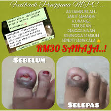 Area kaki bengkak juga bisa menyebar ke pergelangan dan telapak kaki. Ubat Kuku Cagu Cengkam Bengkak Bernanah Bisa Berdarah Ingrown Toenail Toe 100 Dari Minyak Kelapa Asli Dan Herba Trpilih Shopee Malaysia