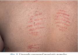 Image result for koebner phenomenon psoriasis