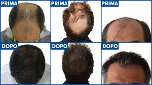 Da giocatore al lecce con un mucchio di capelli fino alla zazzera da allenatore. Antonio Conte Il Segreto Del Suo Trapianto Di Capelli