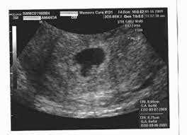 The other twin had implanted at the top of my uterus, and i have a severely tilted uterus. My Identical Twins Ultrasound At 6 5 Weeks